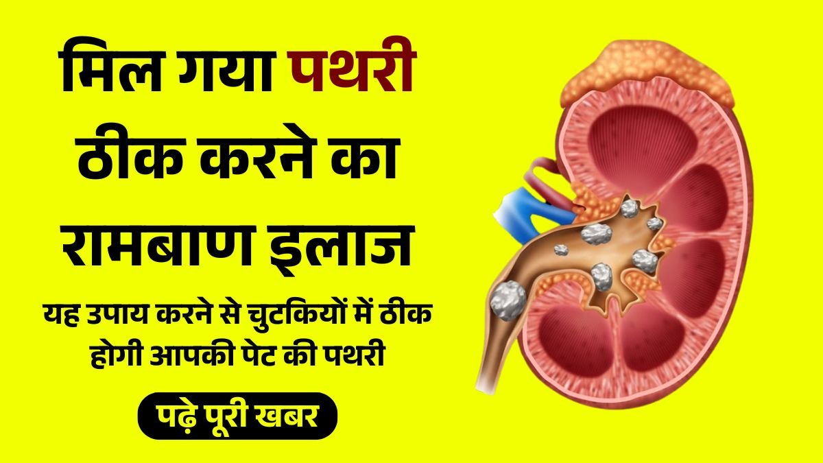 मिल गया पथरी ठीक करने का रामबाण इलाज, यह उपाय करने से चुटकियों में ठीक होगी आपकी पेट की पथरी