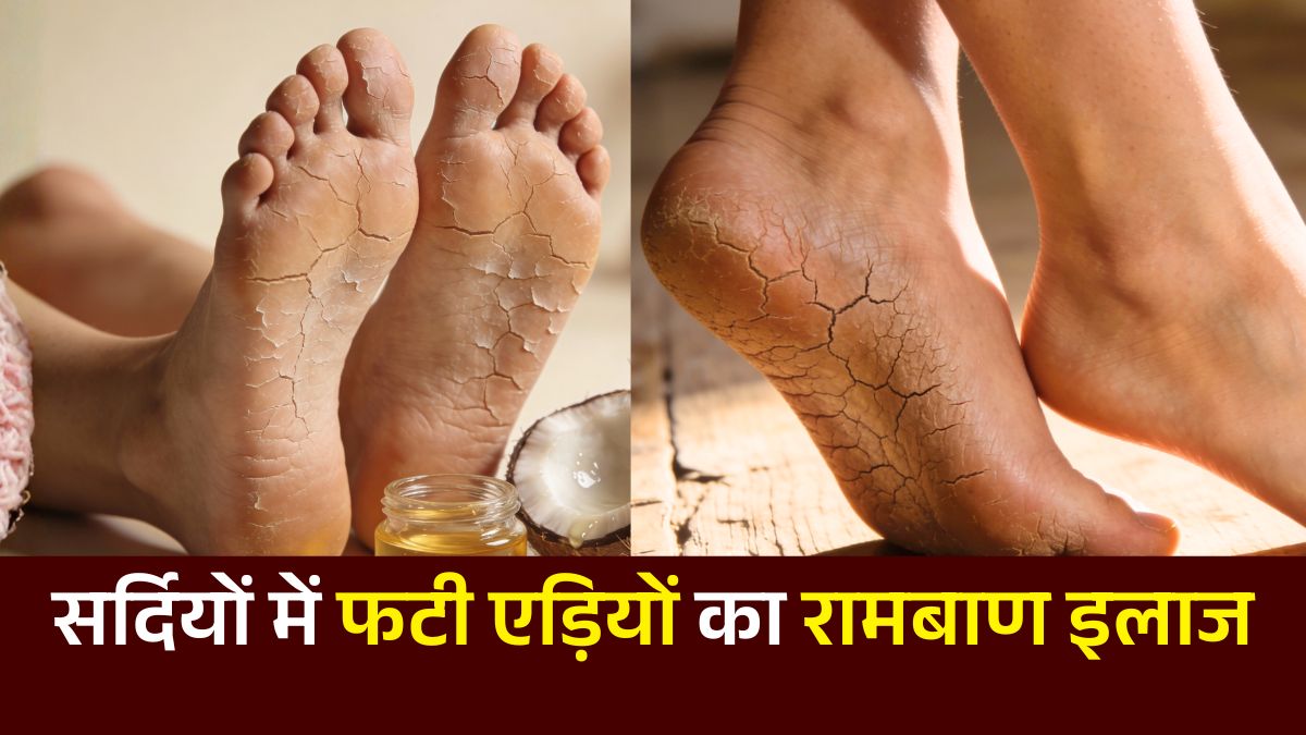 सर्दियों में फटी एड़ियों का रामबाण इलाज: अपनाएं ये 3 घरेलू उपाय और पाएं मक्खन जैसी मुलायम एड़ियां (Cracked Heels Home Remedy)