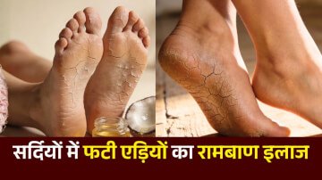 सर्दियों में फटी एड़ियों का रामबाण इलाज: अपनाएं ये 3 घरेलू उपाय और पाएं मक्खन जैसी मुलायम एड़ियां (Cracked Heels Home Remedy)